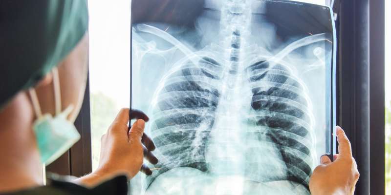 Verem Hastalığı (Tüberküloz) Nedir? Belirtileri ve Tedavi Yöntemleri Nelerdir?